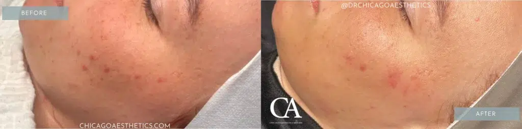 ipl treatment before and after photo by chicago aesthetics surgery & med spa in chicago, il