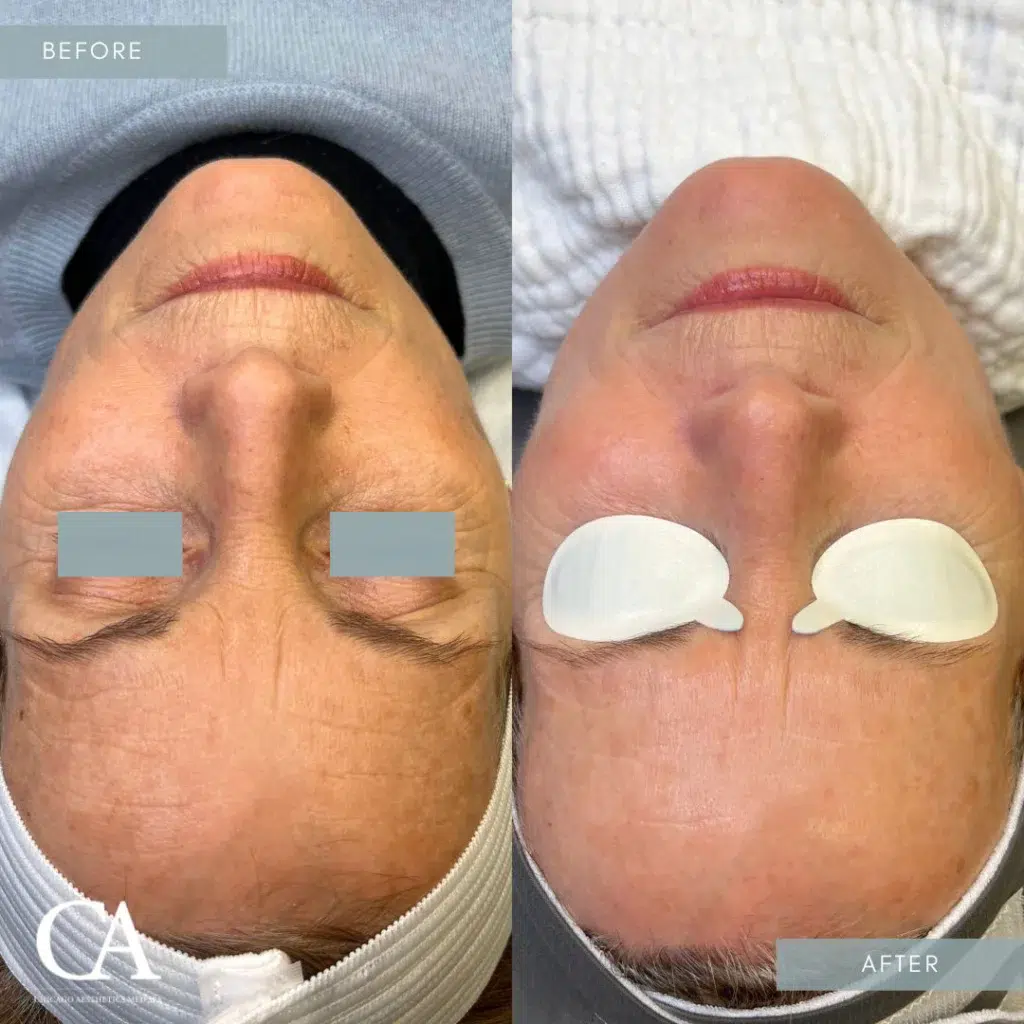 ipl treatment before and after photo by chicago aesthetics surgery & med spa in chicago, il