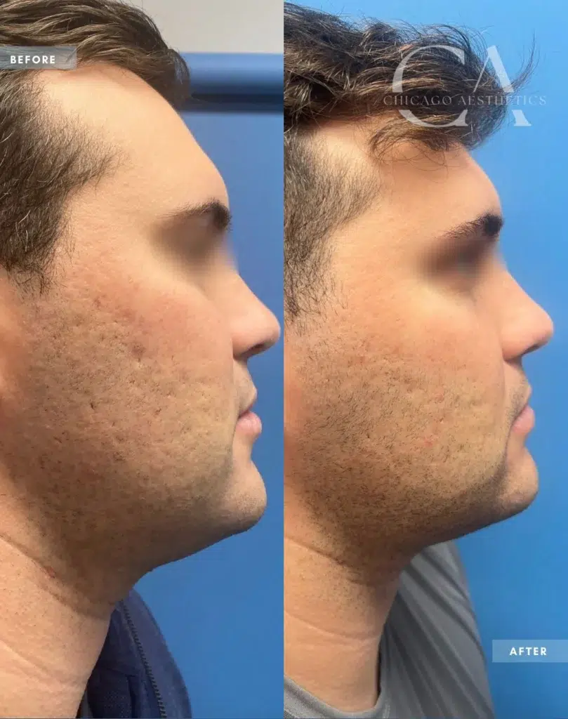 ipl treatment before and after photo by chicago aesthetics surgery & med spa in chicago, il