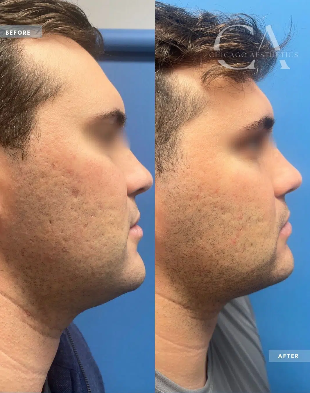 ipl treatment before and after photo by chicago aesthetics surgery & med spa in chicago, il