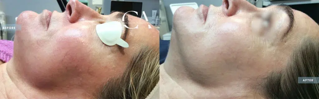 ipl treatment before and after photo by chicago aesthetics surgery & med spa in chicago, il