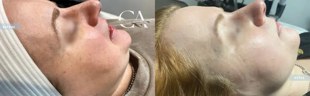 ipl treatment before and after photo by chicago aesthetics surgery & med spa in chicago, il