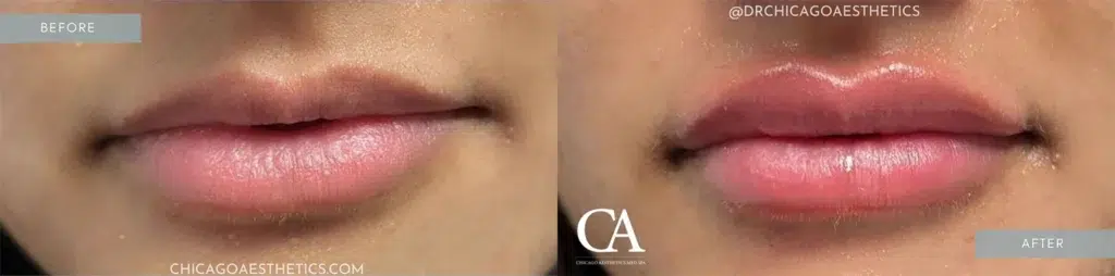 lip filler before and after photo by chicago aesthetics surgery & med spa in chicago, il