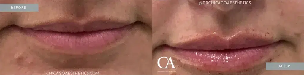 lip filler before and after photo by chicago aesthetics surgery & med spa in chicago, il
