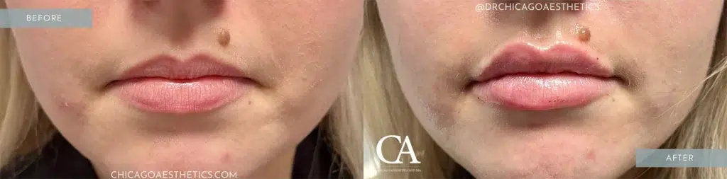 lip filler before and after photo by chicago aesthetics surgery & med spa in chicago, il