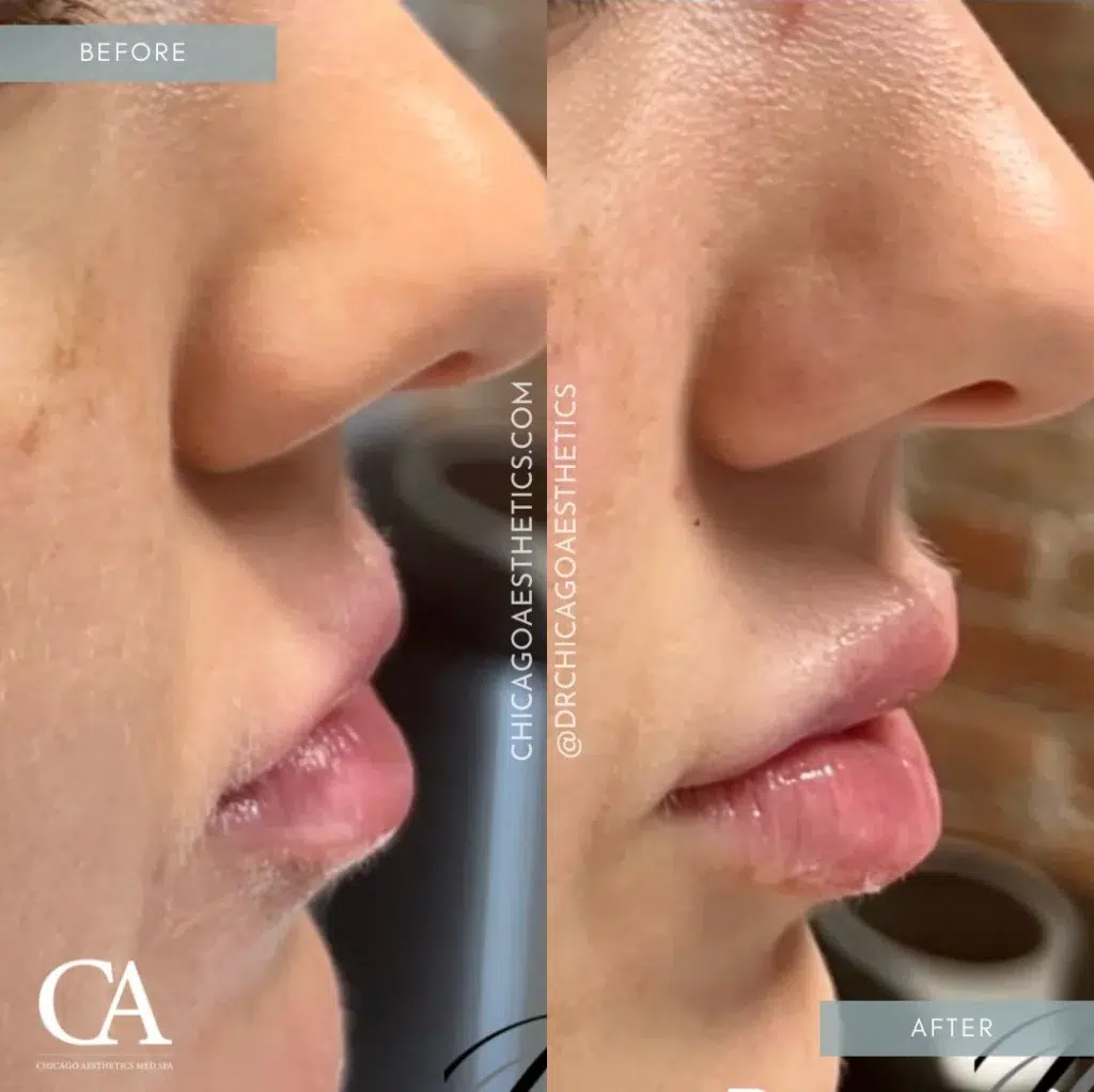 lip filler before and after photo by chicago aesthetics surgery & med spa in chicago, il