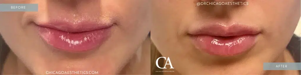 lip filler before and after photo by chicago aesthetics surgery & med spa in chicago, il