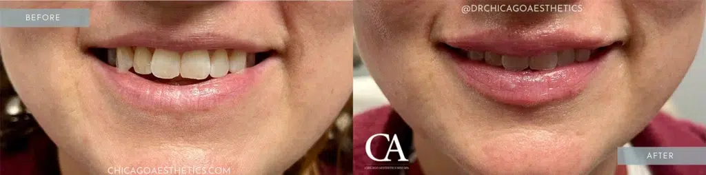 lip filler before and after photo by chicago aesthetics surgery & med spa in chicago, il