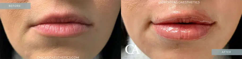 lip filler before and after photo by chicago aesthetics surgery & med spa in chicago, il