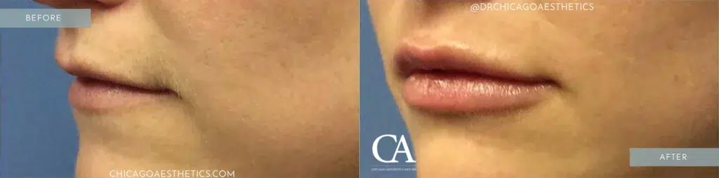 lip filler before and after photo by chicago aesthetics surgery & med spa in chicago, il
