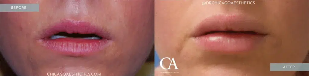 lip filler before and after photo by chicago aesthetics surgery & med spa in chicago, il