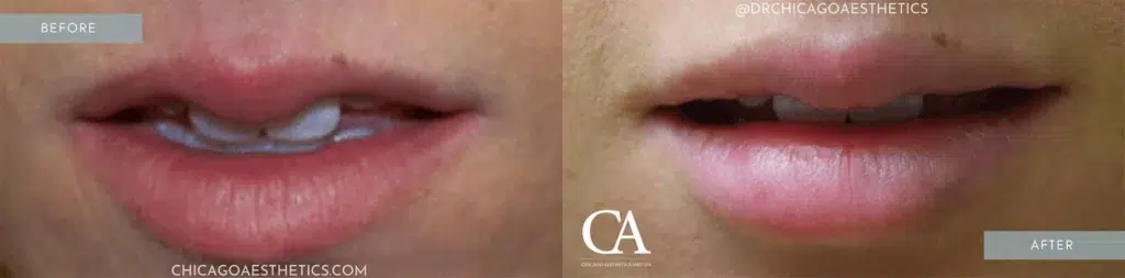 lip filler before and after photo by chicago aesthetics surgery & med spa in chicago, il