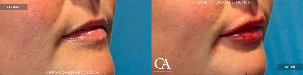 lip filler before and after photo by chicago aesthetics surgery & med spa in chicago, il