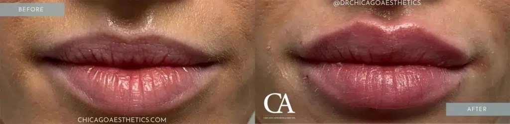 lip filler before and after photo by chicago aesthetics surgery & med spa in chicago, il