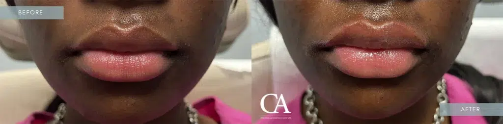 lip filler before and after photo by chicago aesthetics surgery & med spa in chicago, il