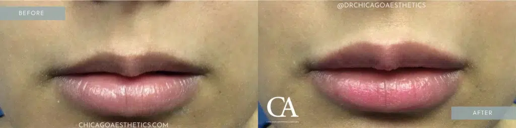lip filler before and after photo by chicago aesthetics surgery & med spa in chicago, il