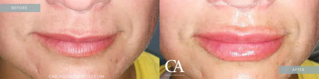 lip filler before and after photo by chicago aesthetics surgery & med spa in chicago, il