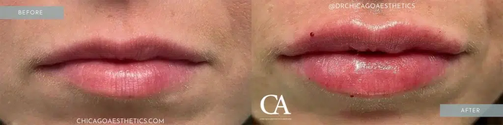 lip filler before and after photo by chicago aesthetics surgery & med spa in chicago, il
