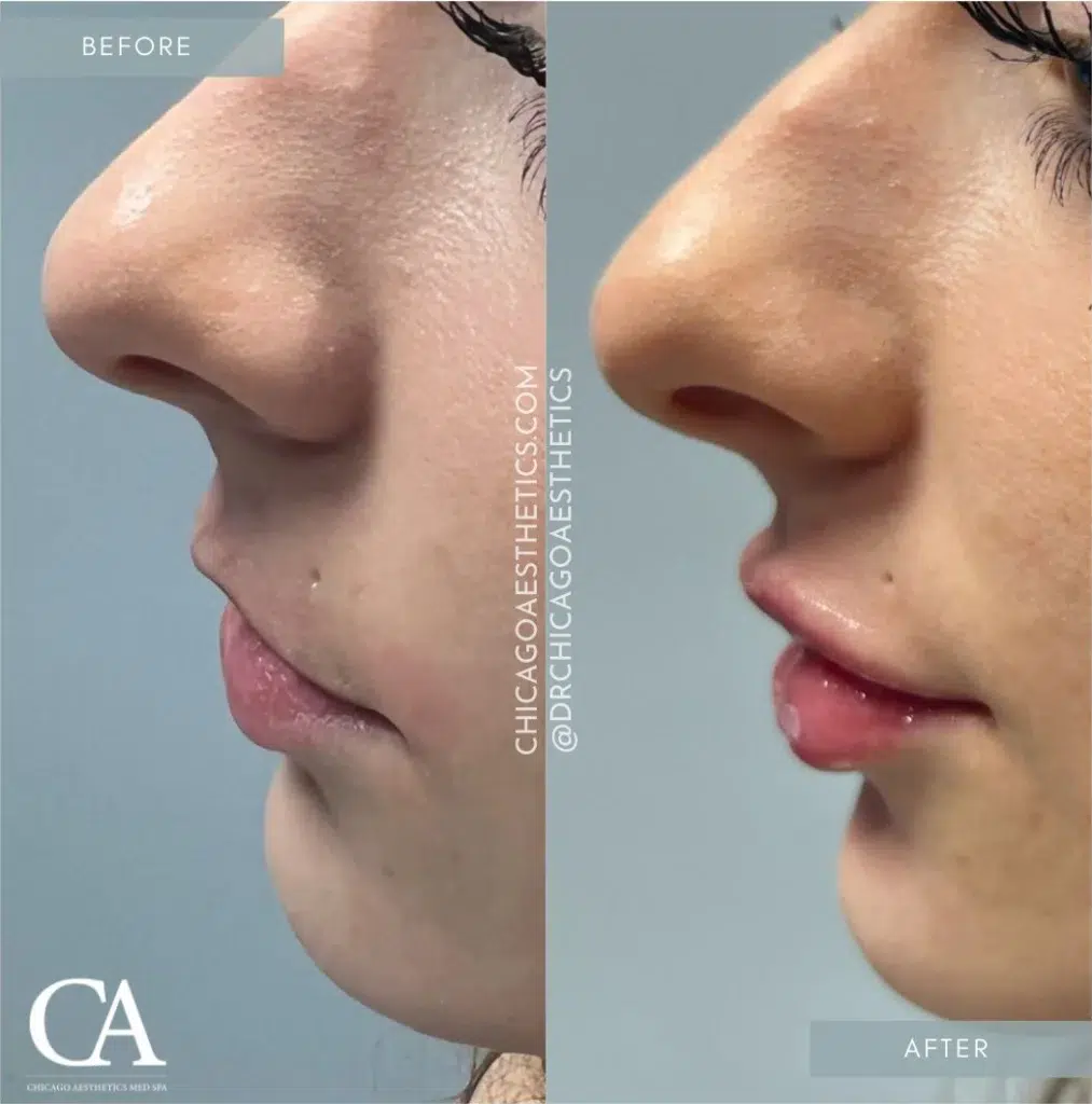 lip filler before and after photo by chicago aesthetics surgery & med spa in chicago, il