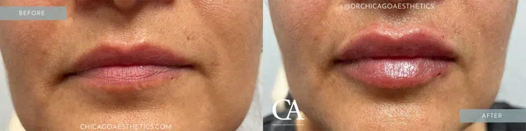 lip filler before and after photo by chicago aesthetics surgery & med spa in chicago, il