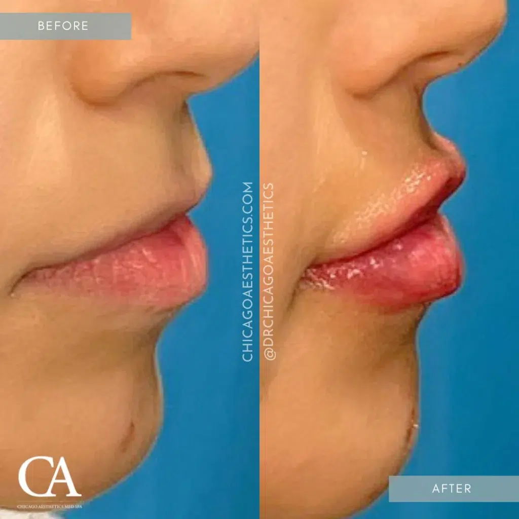 lip filler before and after photo by chicago aesthetics surgery & med spa in chicago, il