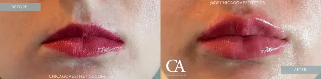 lip filler before and after photo by chicago aesthetics surgery & med spa in chicago, il