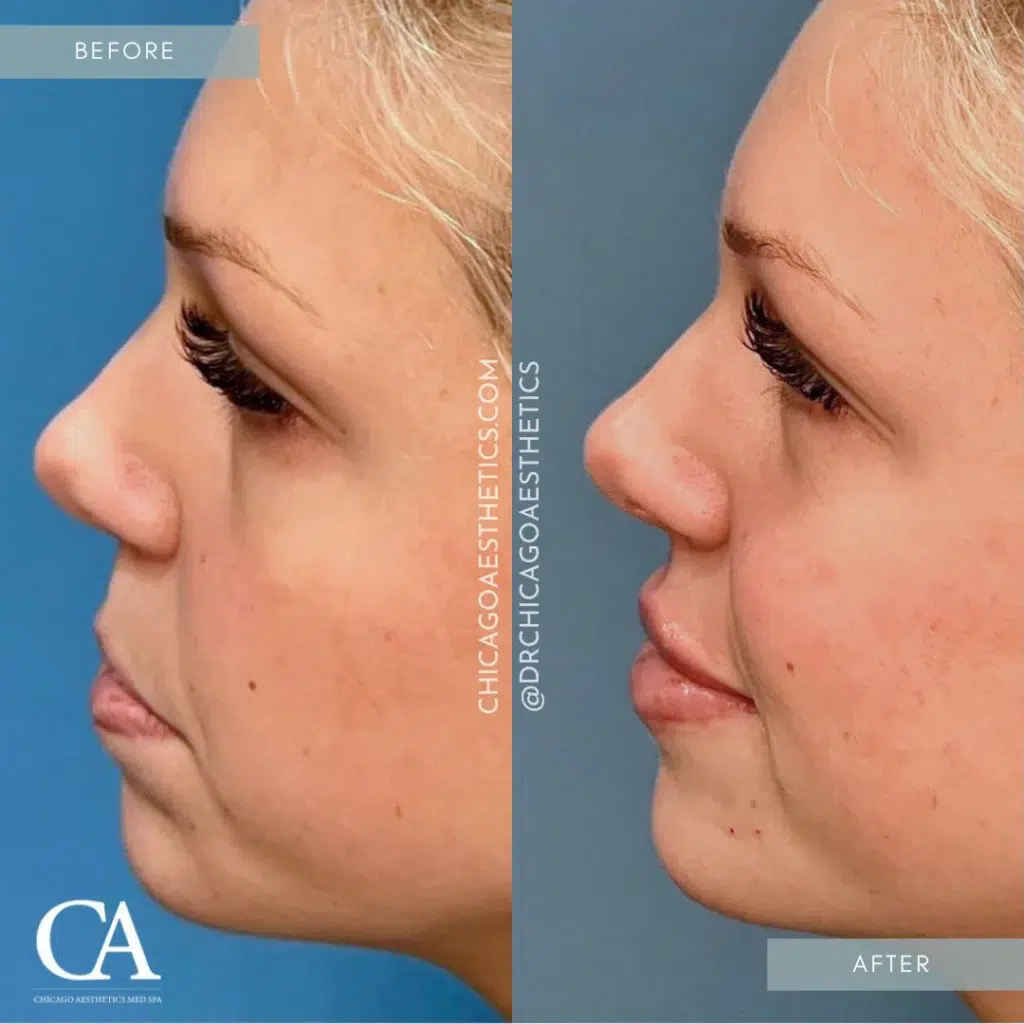 lip filler before and after photo by chicago aesthetics surgery & med spa in chicago, il