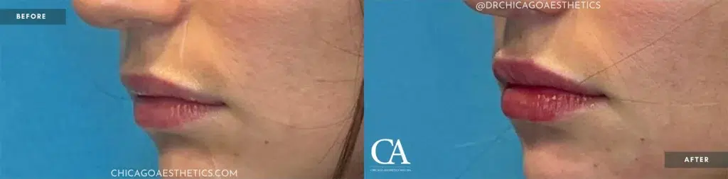 lip filler before and after photo by chicago aesthetics surgery & med spa in chicago, il