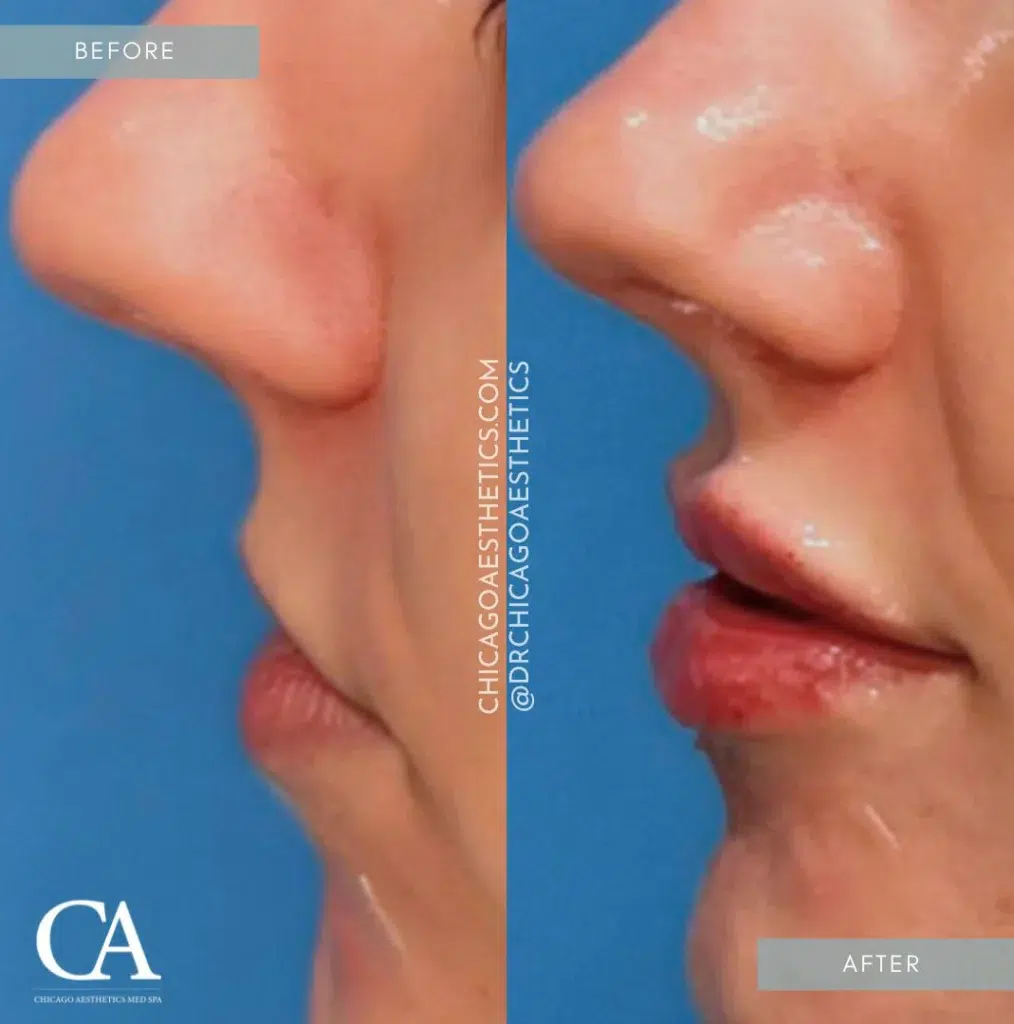 lip filler before and after photo by chicago aesthetics surgery & med spa in chicago, il