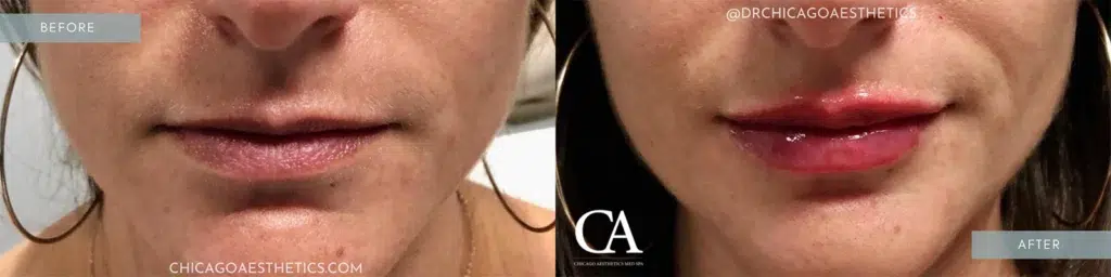 lip filler before and after photo by chicago aesthetics surgery & med spa in chicago, il