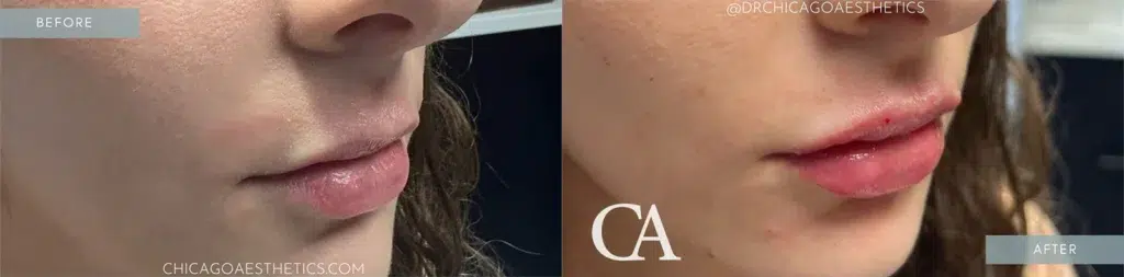 lip filler before and after photo by chicago aesthetics surgery & med spa in chicago, il