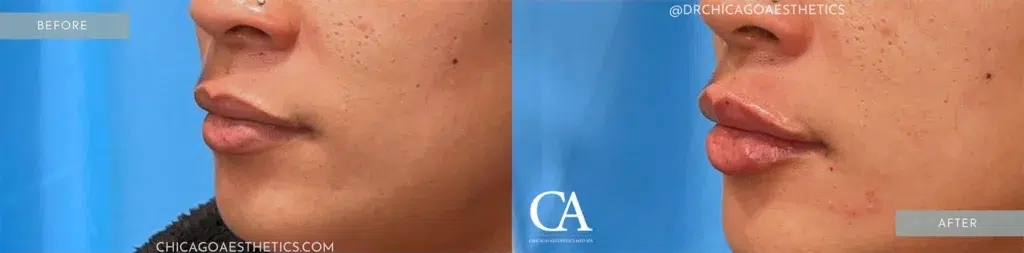 lip filler before and after photo by chicago aesthetics surgery & med spa in chicago, il