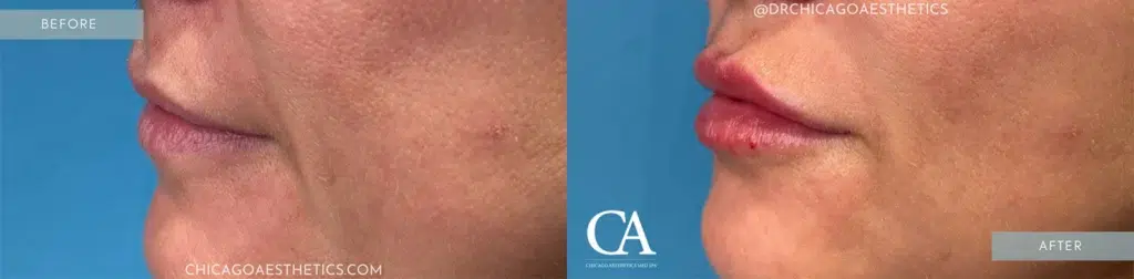lip filler before and after photo by chicago aesthetics surgery & med spa in chicago, il