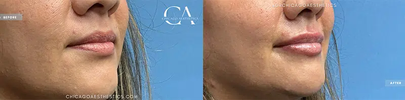 lip filler before and after photo by chicago aesthetics surgery & med spa in chicago, il