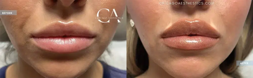 lip filler before and after photo by chicago aesthetics surgery & med spa in chicago, il