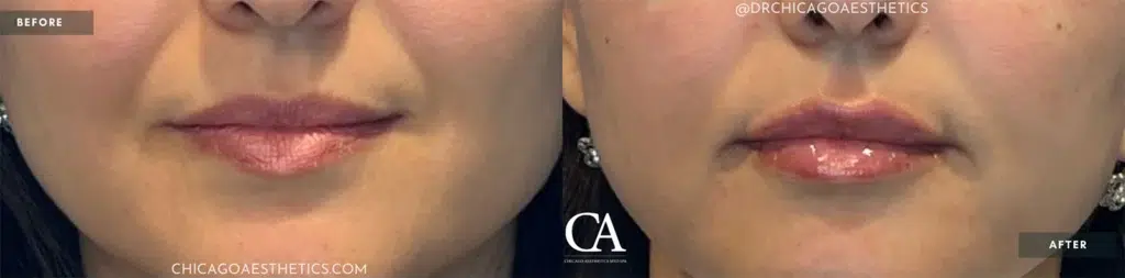 lip filler before and after photo by chicago aesthetics surgery & med spa in chicago, il