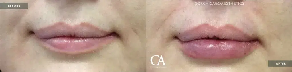 lip filler before and after photo by chicago aesthetics surgery & med spa in chicago, il