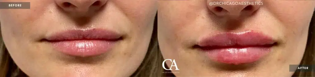 lip filler before and after photo by chicago aesthetics surgery & med spa in chicago, il