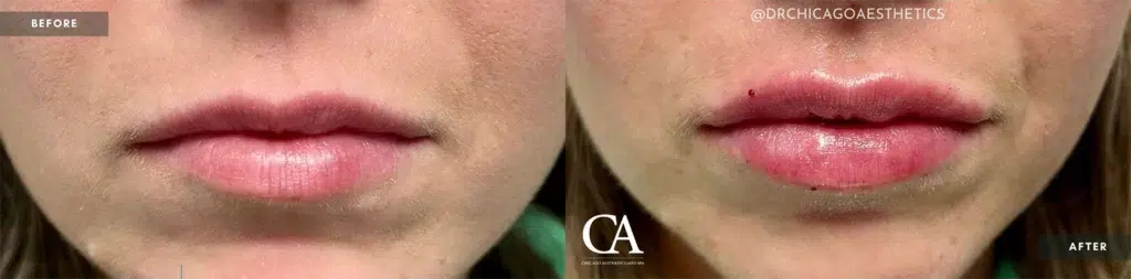 lip filler before and after photo by chicago aesthetics surgery & med spa in chicago, il