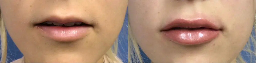 lip filler before and after photo by chicago aesthetics surgery & med spa in chicago, il