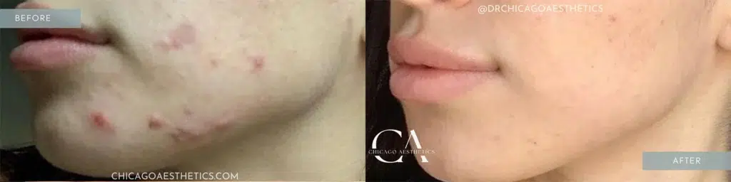 microneedling before and after photo by chicago aesthetics surgery & med spa in chicago, il