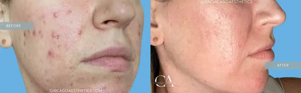 microneedling before and after photo by chicago aesthetics surgery & med spa in chicago, il