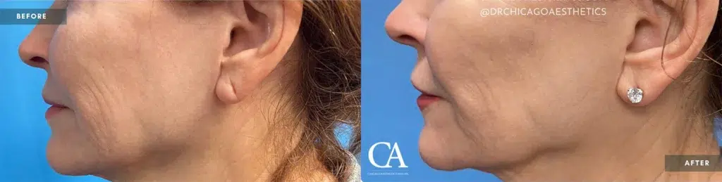 morpheus8 before and after photo by chicago aesthetics surgery & med spa in chicago, il