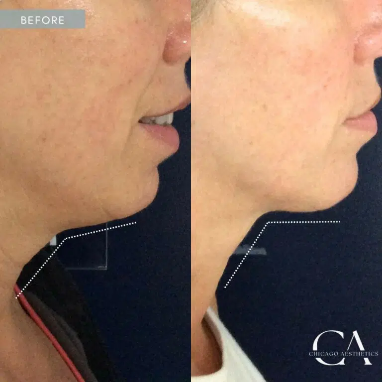 morpheus8 before and after photo by chicago aesthetics surgery & med spa in chicago, il