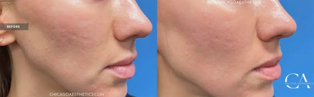 morpheus8 before and after photo by chicago aesthetics surgery & med spa in chicago, il