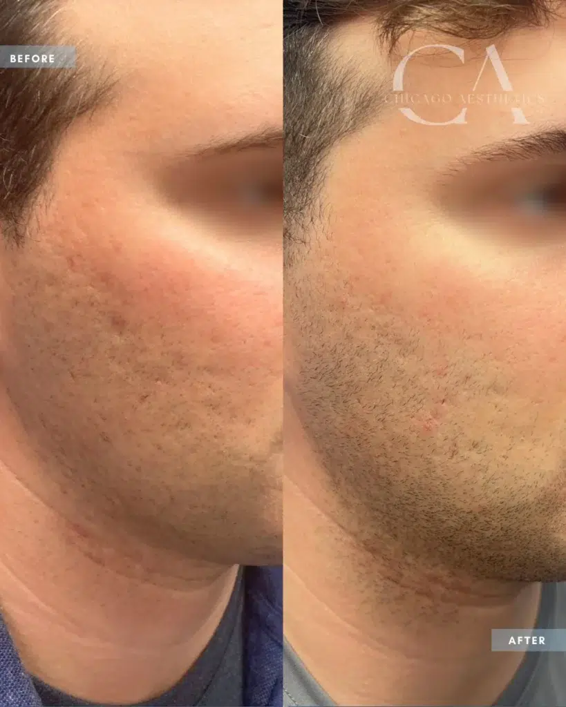 morpheus8 before and after photo by chicago aesthetics surgery & med spa in chicago, il