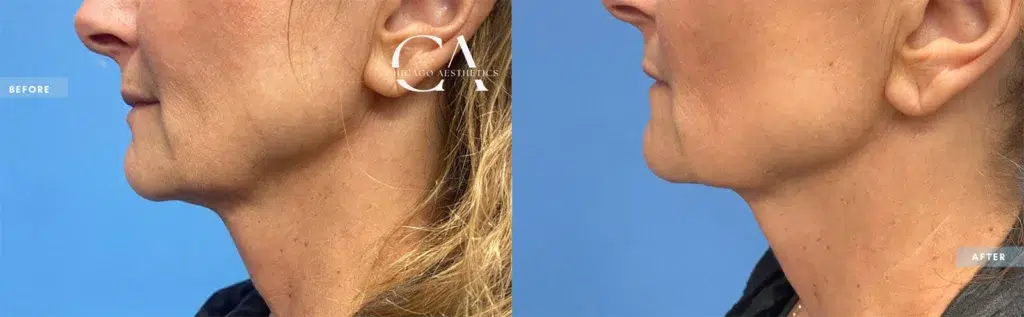 morpheus8 before and after photo by chicago aesthetics surgery & med spa in chicago, il
