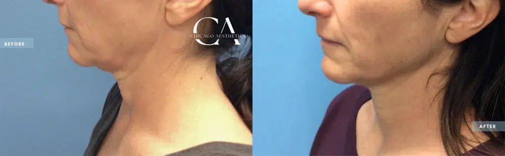 morpheus8 before and after photo by chicago aesthetics surgery & med spa in chicago, il