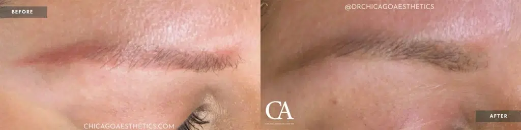 permanent makeup removal before and after photo by chicago aesthetics surgery & med spa in chicago, il