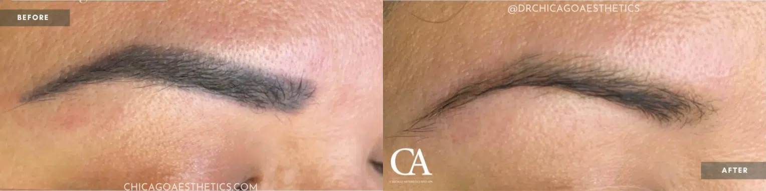 permanent makeup removal before and after photo by chicago aesthetics surgery & med spa in chicago, il